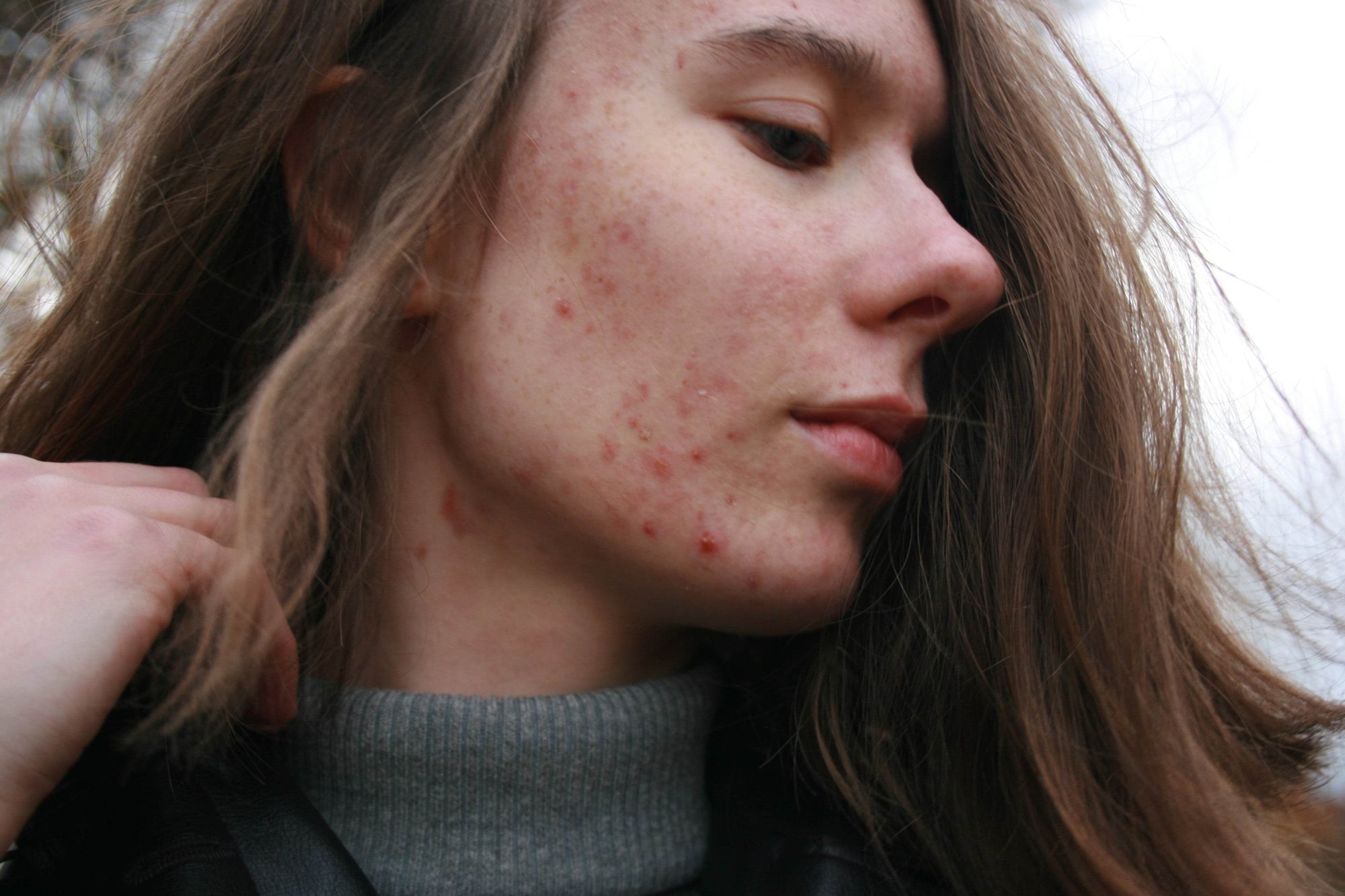 Vette huid en Acne - Ilse de Beaute